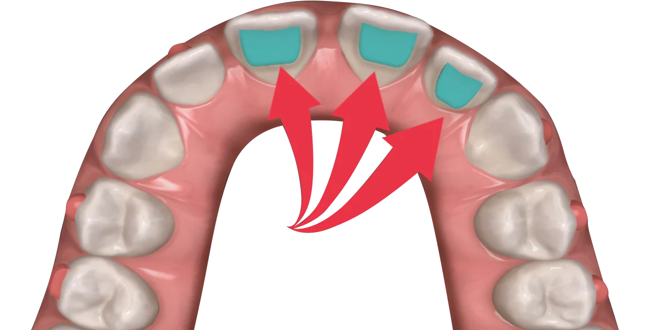 Bite Turbos in Invisible Orthodontics